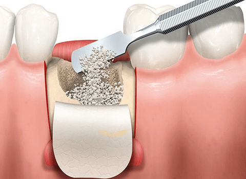 پودر استخوان برای ایمپلنت