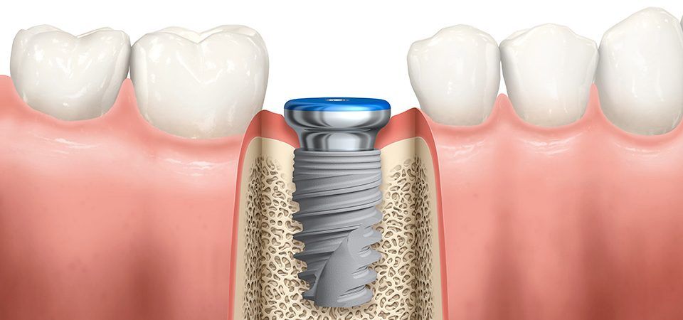 ترس از ایمپلنت