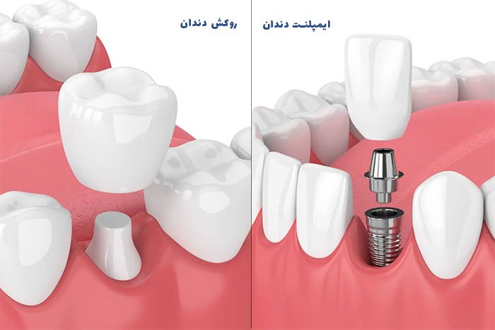 ایمپلنت بهتر است یا روکش؟