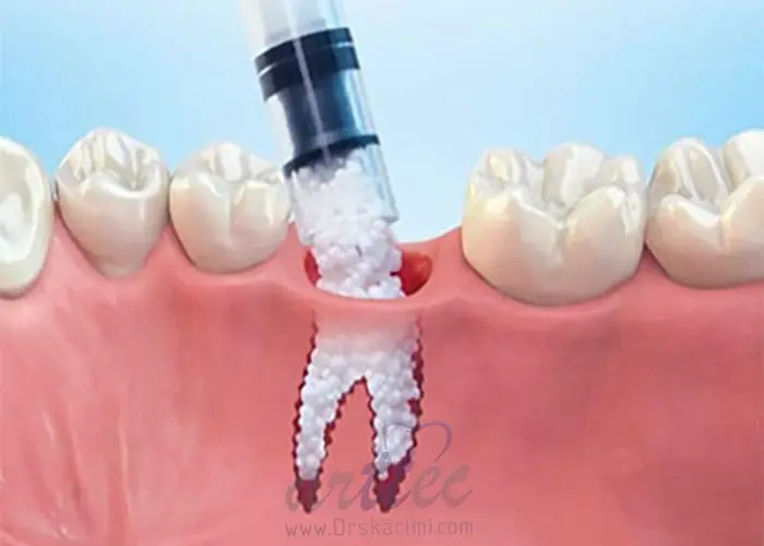 ایا کاشت ایمپلنت با پوکی  استخوان امکان پذیر است؟