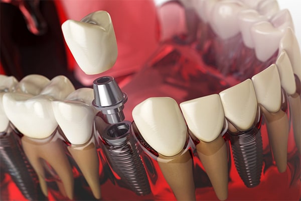 آیا ایمپلنت دندان باعث سرطان میشود ؟