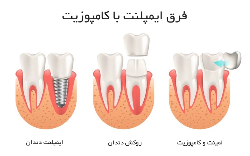 ایمپلنت بهتره یا کامپوزیت